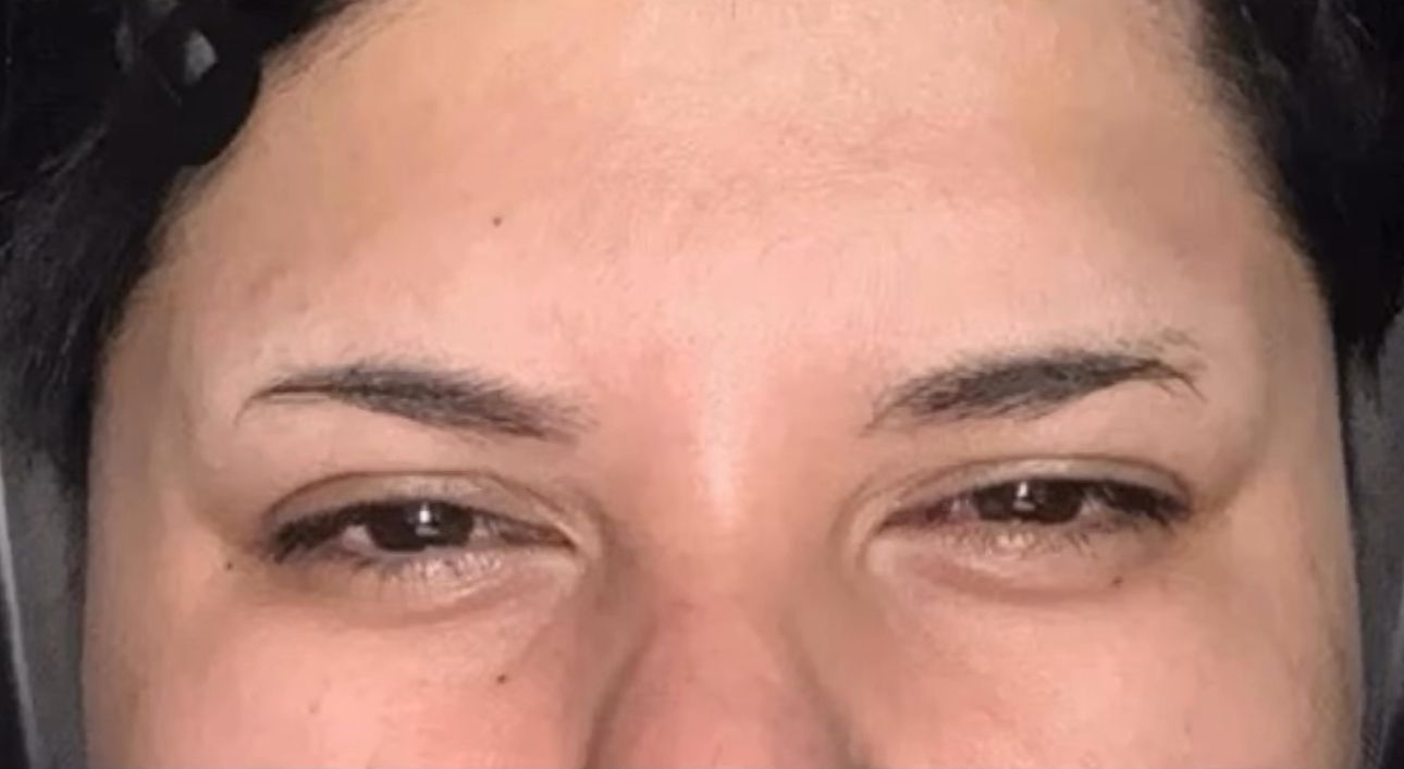 After Botox in Brooklyn – softened 11s at Bayridge Beauty