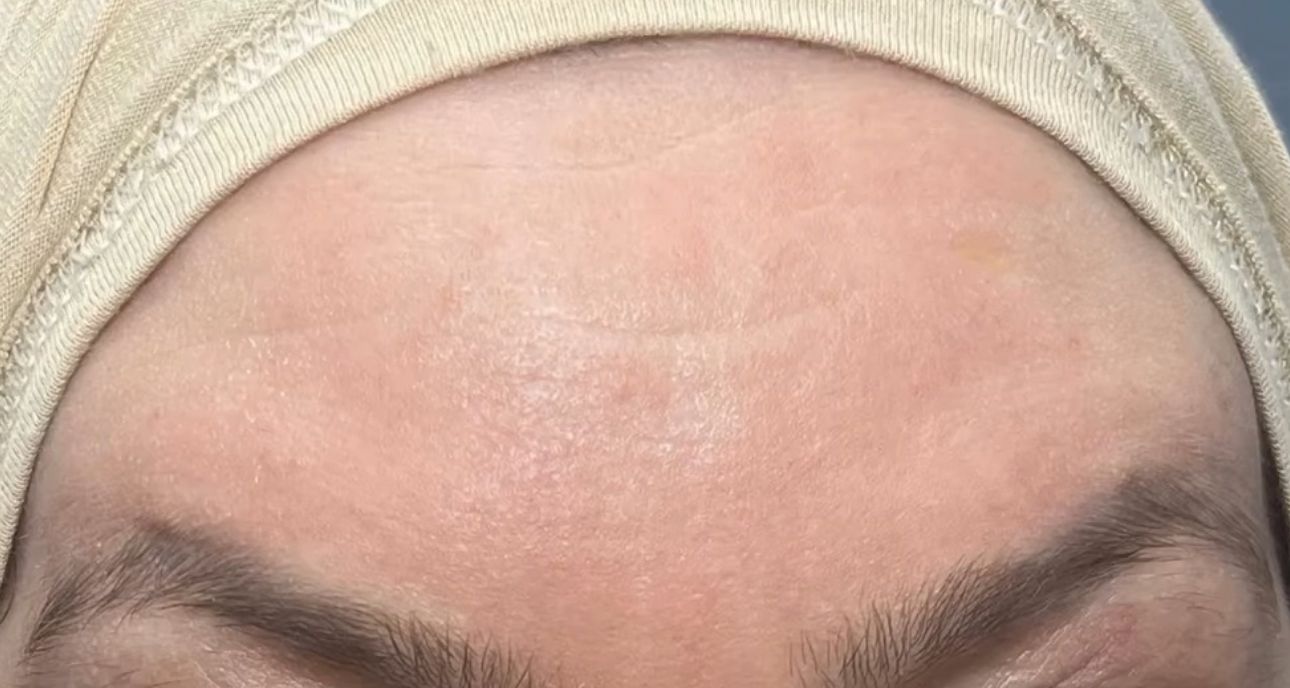 After Botox in Bay Ridge – smoother crow’s feet