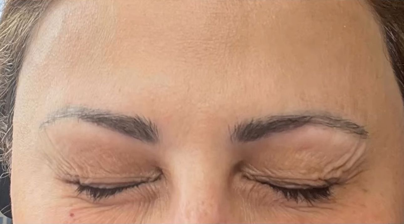 After Botox forehead lines in Brooklyn