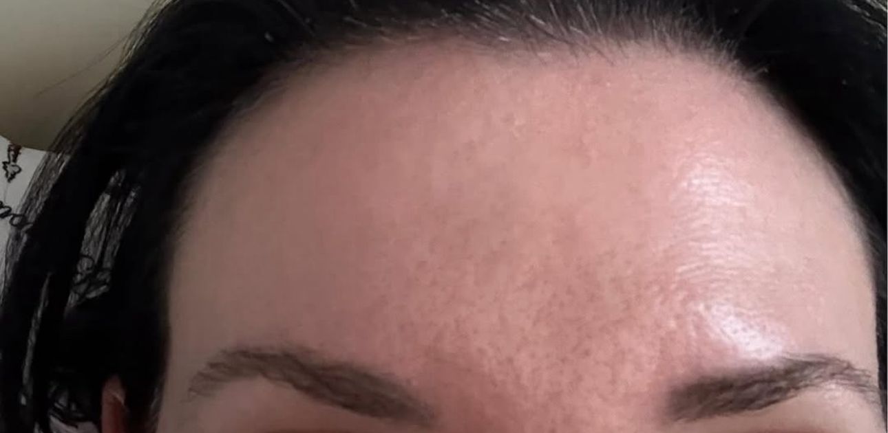 After Botox forehead lines in Brooklyn