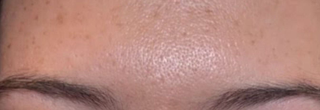 Botox for forehead lines treatment results in Brooklyn