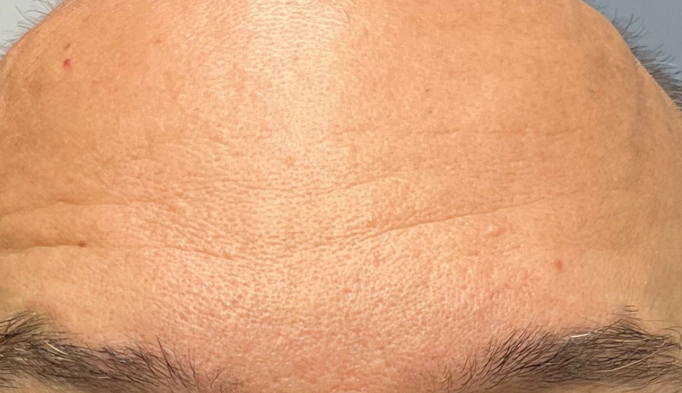 After Botox treatment in Brooklyn