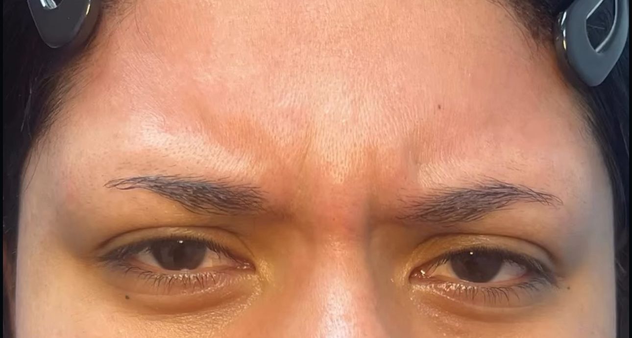 Before Botox in Brooklyn – frown lines (11s) at Bayridge Beauty