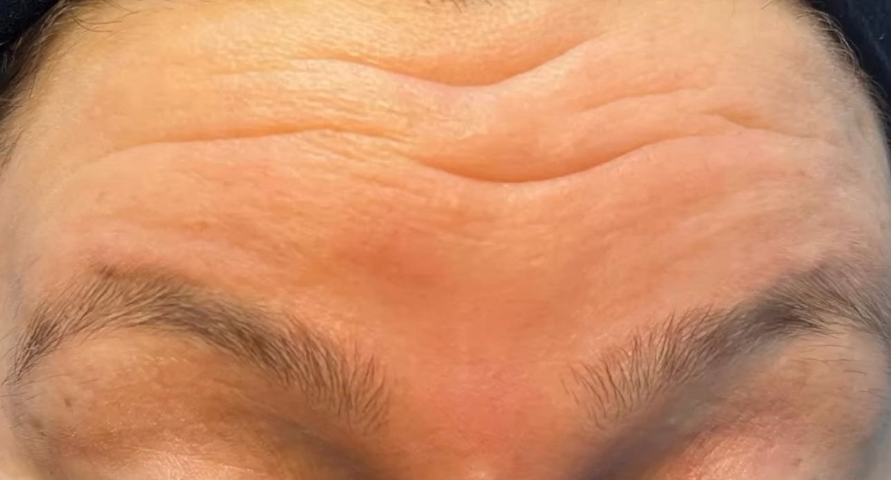 Before Botox in Bay Ridge – crow’s feet