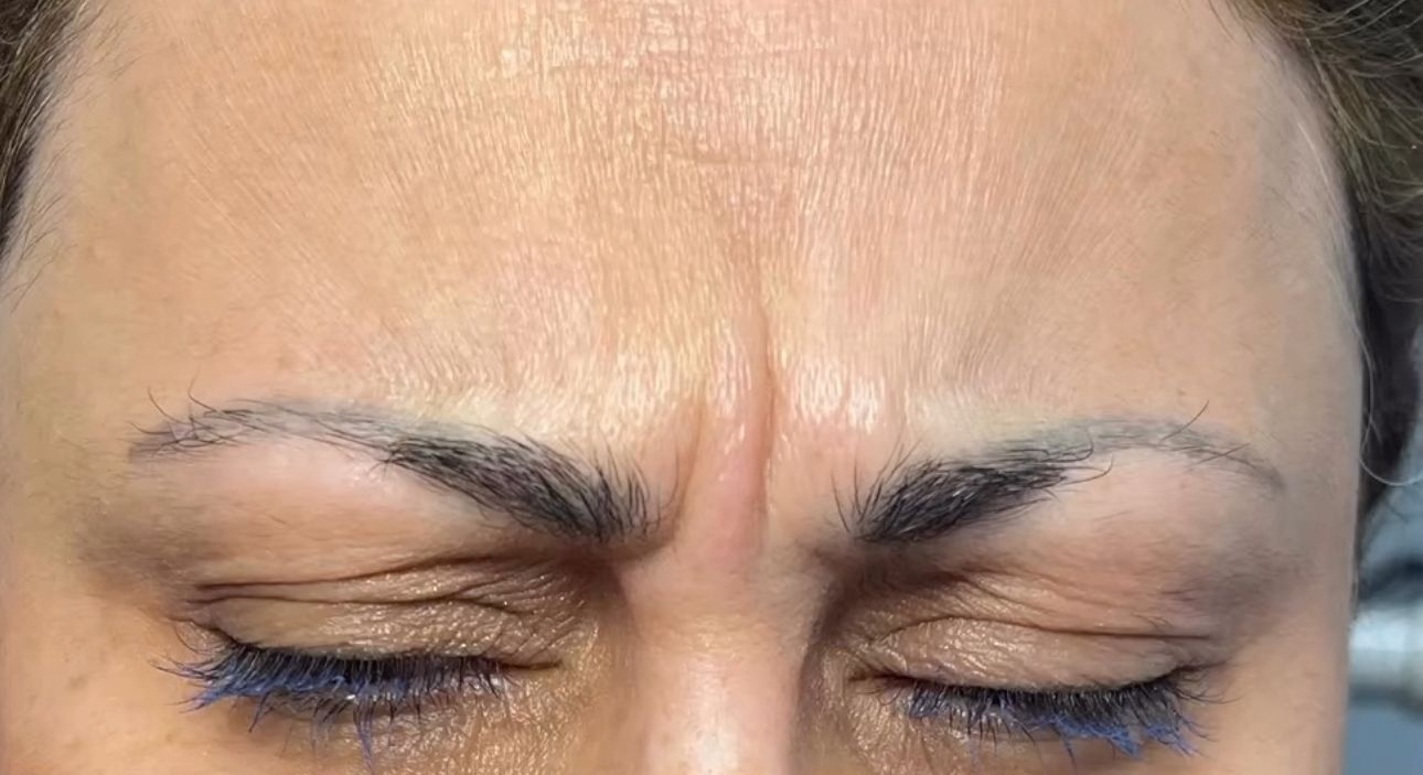 Before Botox forehead lines in Brooklyn