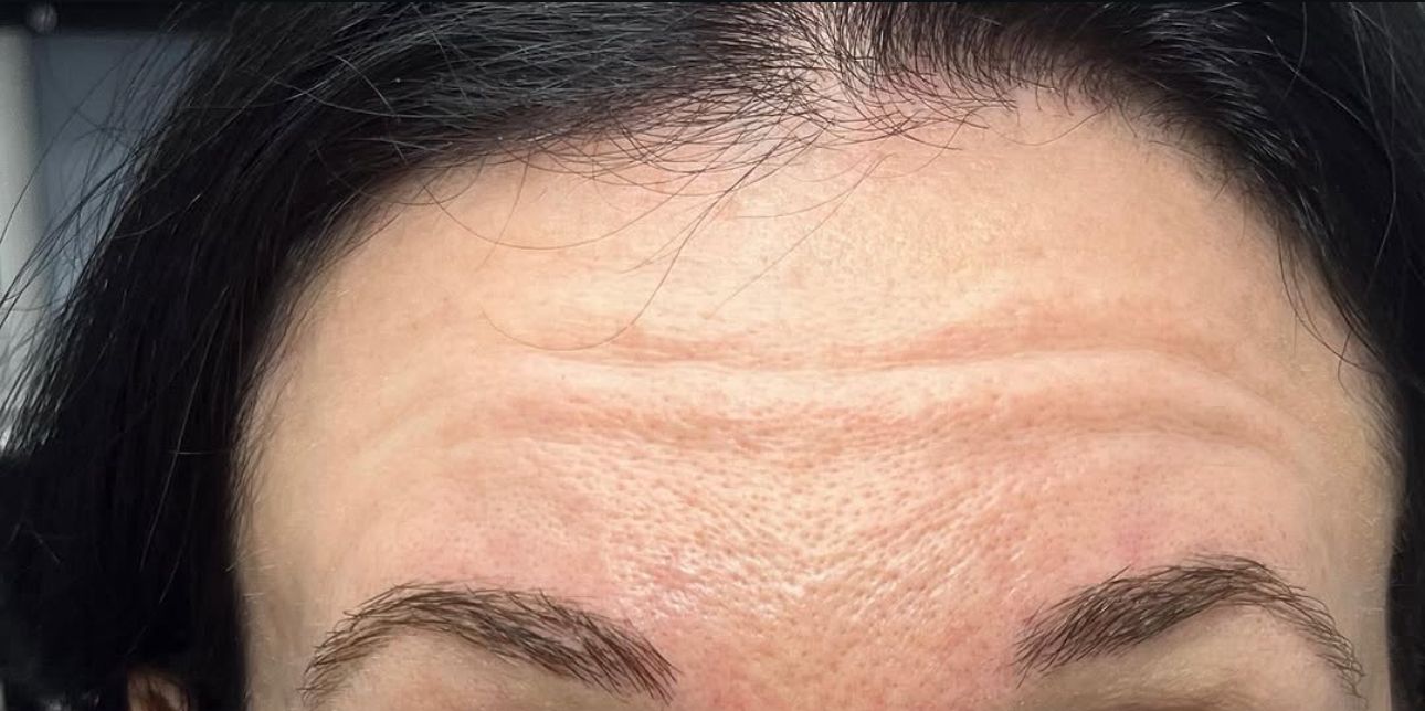 Before Botox forehead lines in Brooklyn