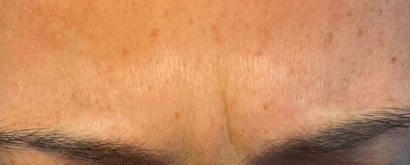 Botox for forehead lines treatment in Brooklyn