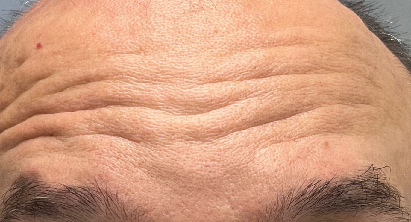 Before Botox treatment in Brooklyn