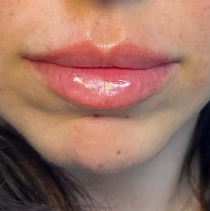Same Brooklyn patient after lip filler with fuller, natural lips at Bayridge Beauty