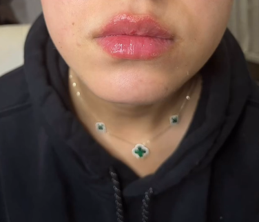 After Russian lip filler technique with defined cupid’s bow in Brooklyn