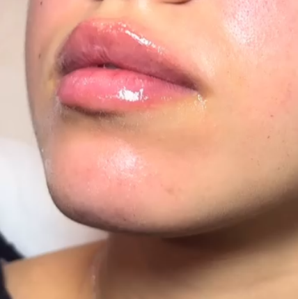 After vertical height lip filler treatment showing lifted natural results in Brooklyn