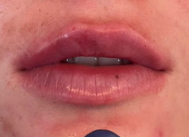 After lip augmentation at Bayridge Beauty in Brooklyn