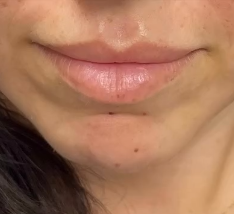 Brooklyn patient before lip filler treatment at Bayridge Beauty