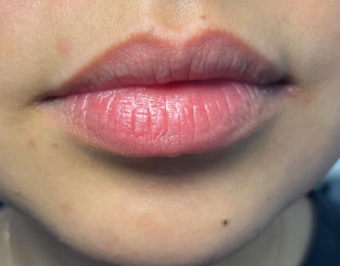 Before lip augmentation at Bayridge Beauty in Bay Ridge Brooklyn