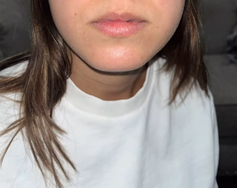 Before Russian lip filler technique at Bayridge Beauty Brooklyn NY