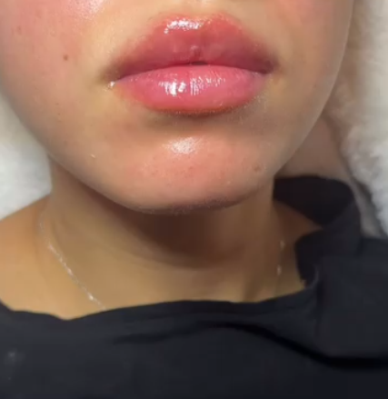 Before vertical height lip filler treatment at Bayridge Beauty in Brooklyn